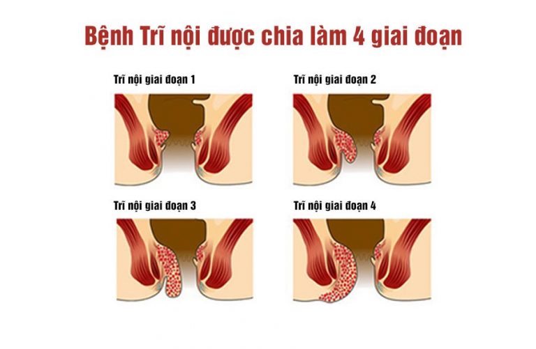 Các biểu hiện, triệu chứng của bệnh trĩ nội nên biết để điều trị