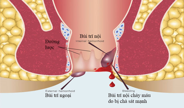 Đi ngoài ra máu tươi nhỏ giọt: Coi chứng mắc trĩ cấp độ 3, 4!