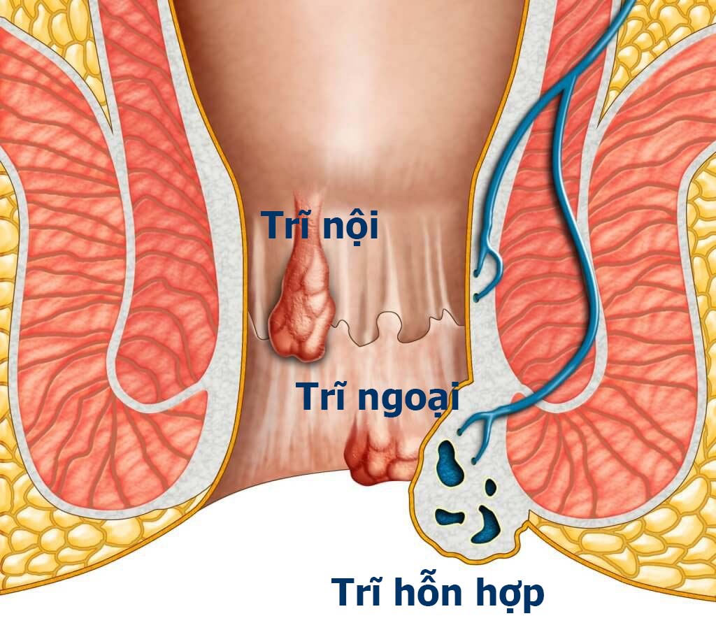 Hình ảnh chi tiết trĩ nội và trĩ ngoại. Làm thế nào để co búi trĩ tại nhà?