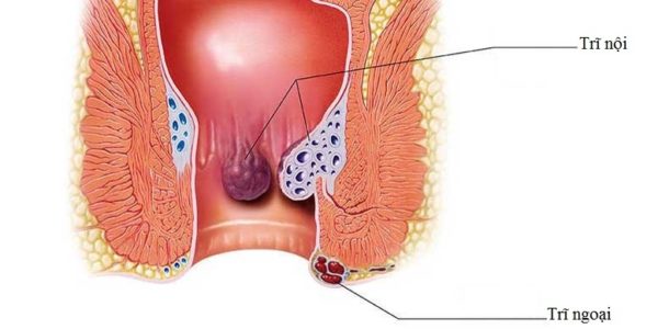 Thảo dược quý cho người bị trĩ nội, trĩ ngoại: Lá lốt